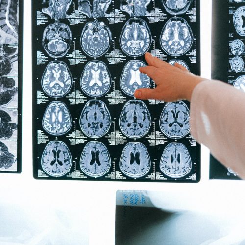 Hersenen Ziekte van Parkinson